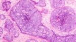 Using SNAs in Cancer Vaccines