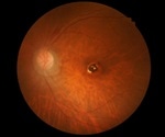 Combining Electron Paramagnetic Resonance and Atomic Force Microscopy to Elucidate Oxidative Stress in Eye Disorders