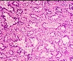How SpatialOMx is Delivering New Insights into Disease Research
