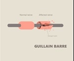 Guillain-Barré Syndrome Treatment